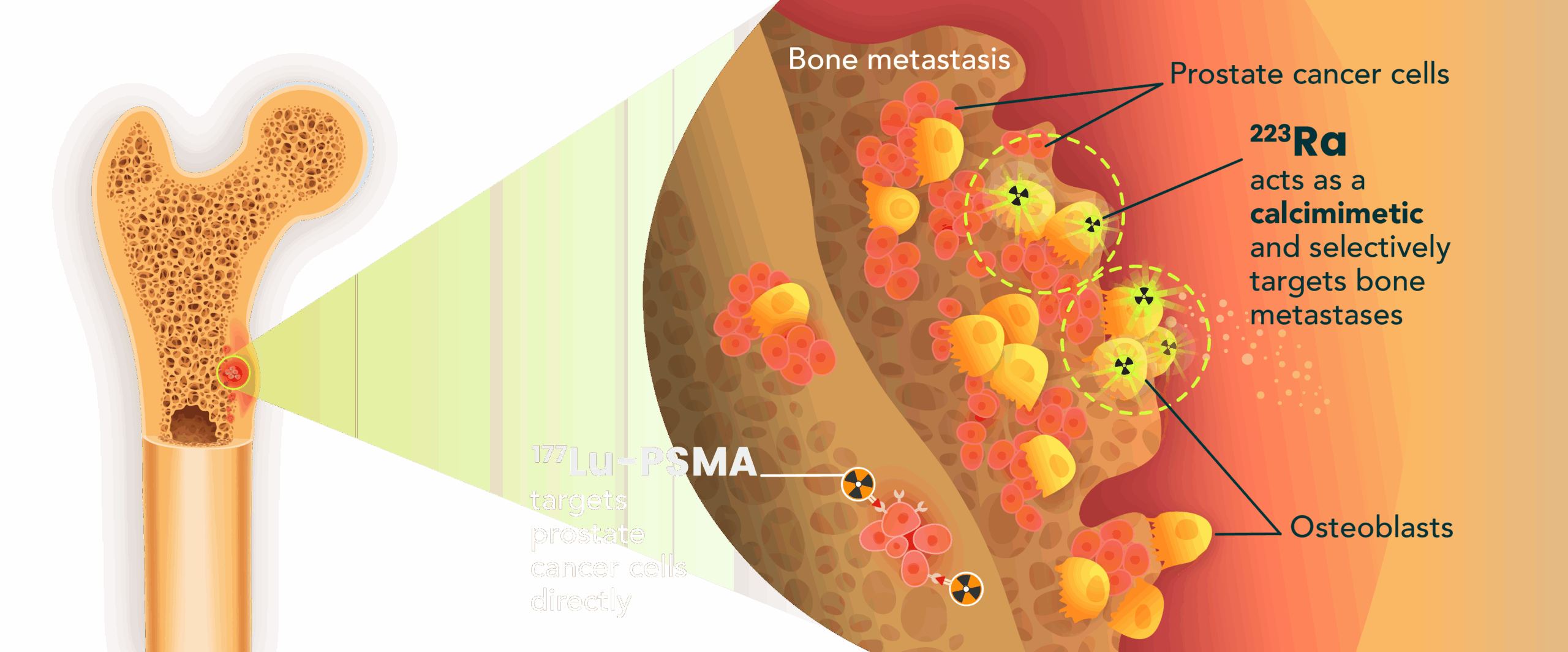 Bone metastasis